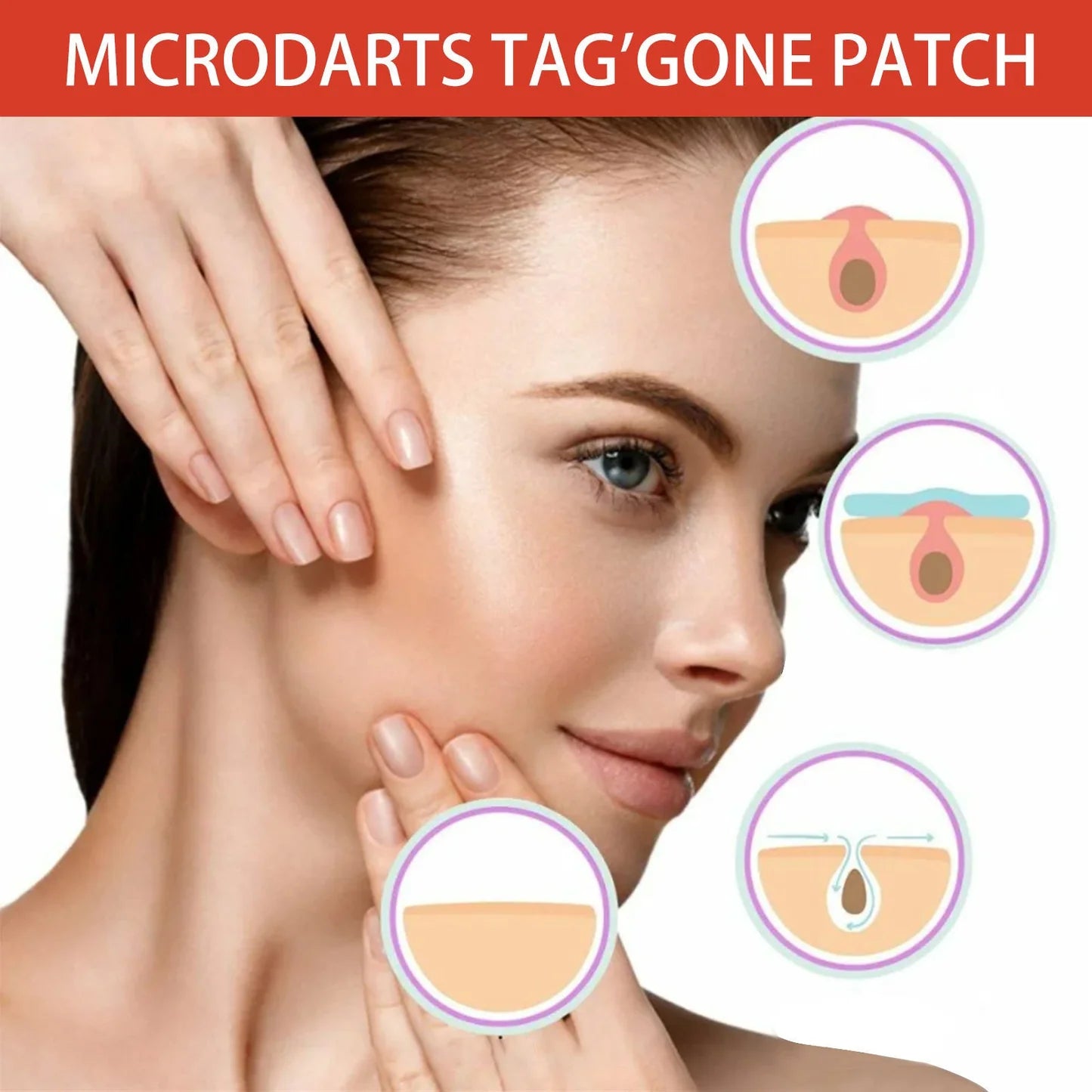 Close-up of Acne Clearing Patch applied to skin, treating acne and blemishes. 144 Acne Clearing Patches in a neatly organized pack for acne removal and spot treatment.