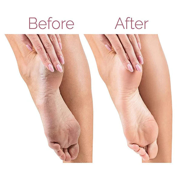 "Electric Pedicure Foot File and Callus Remover – Rechargeable device for smooth, soft feet, effectively removes hard skin and calluses."